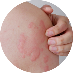 Hives that “blanch”